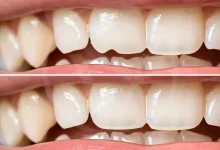 composite-bonding-in-blackpool:-a-quick-and-affordable-solution-for-a-beautiful-smile