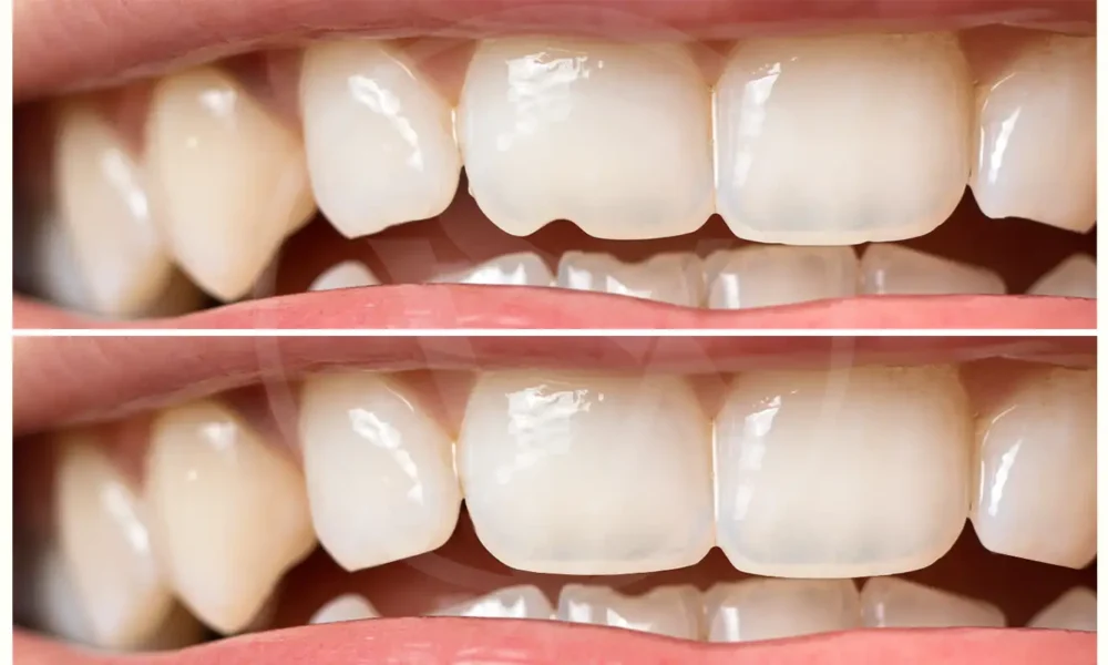 composite-bonding-in-blackpool:-a-quick-and-affordable-solution-for-a-beautiful-smile